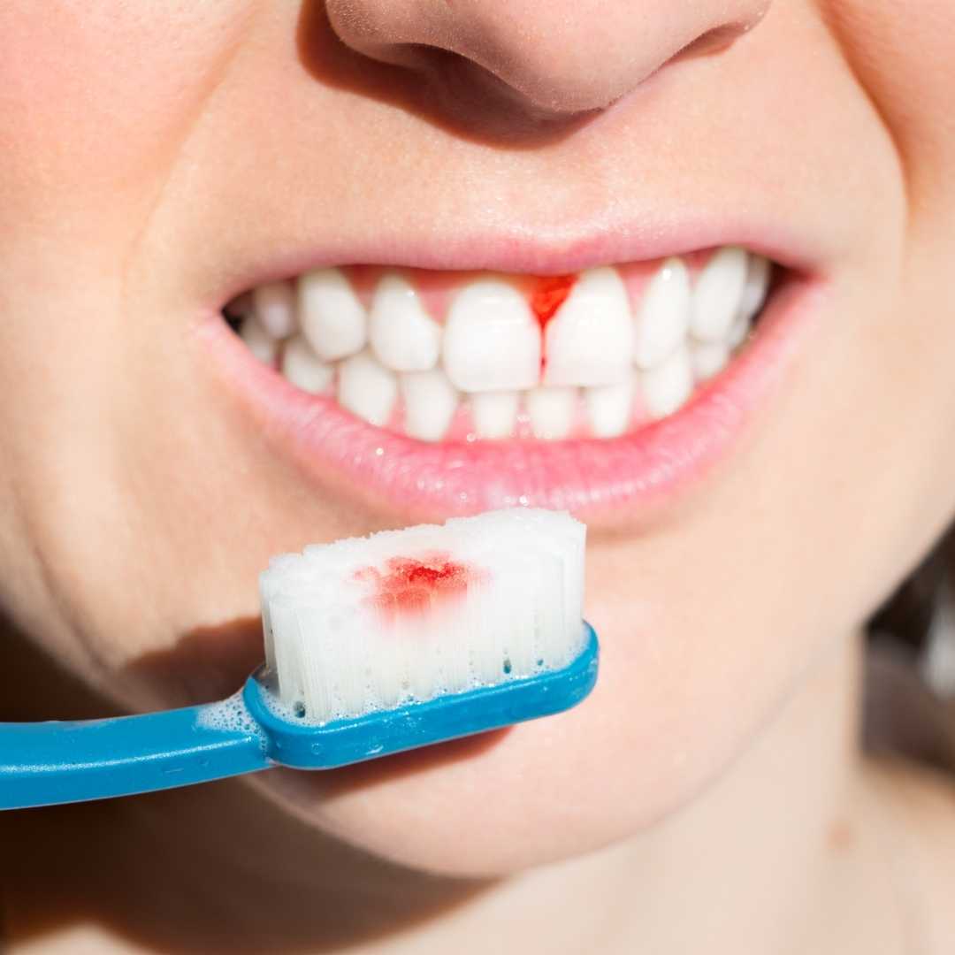 Diş Eti Tedavisi Neden Gereklidir